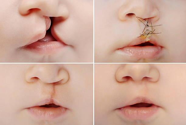 cleft lip surgery and cleft rhinoplasty