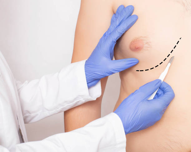 Gynecomastia surgery