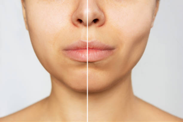 buccal pad fat removal