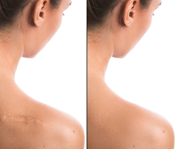 Flap Reconstruction Surgery
