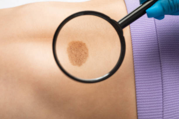 birthmark removal