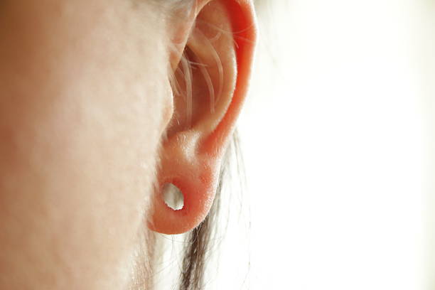 Lobuloplasty