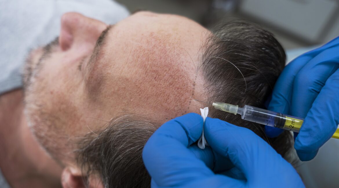 Hair Loss in Bangalore