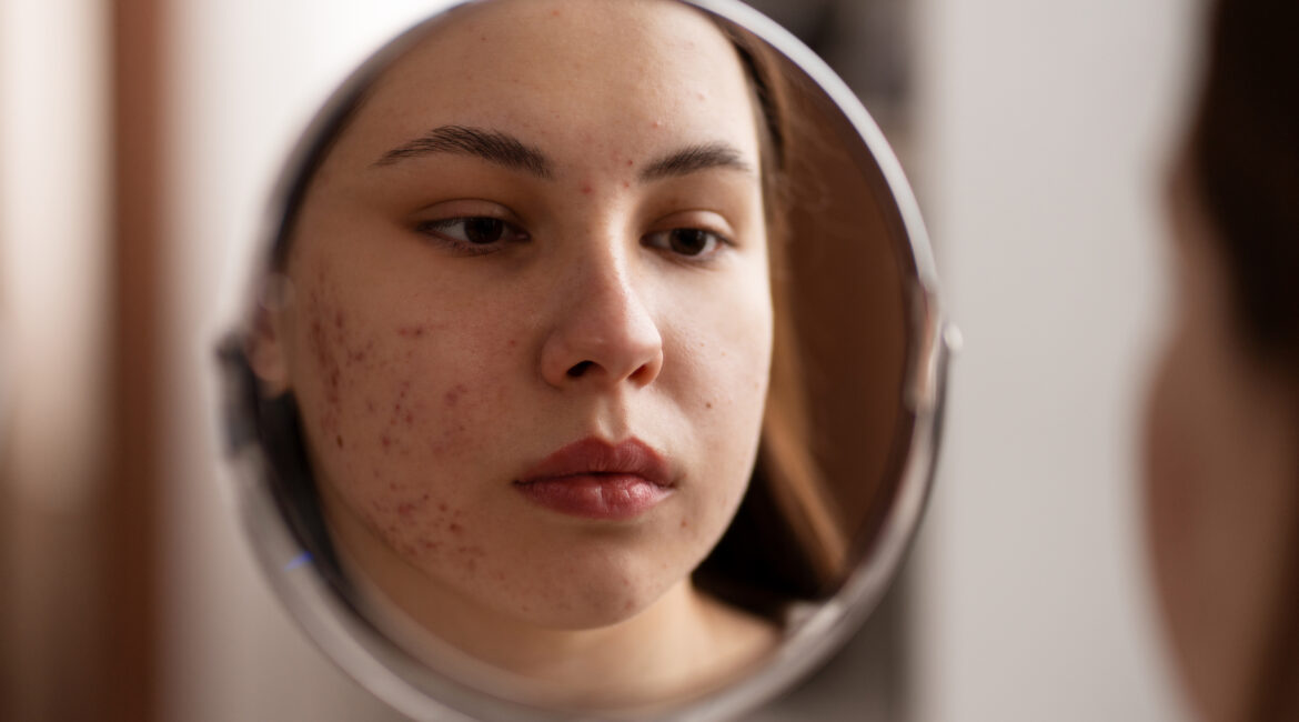 Acne Scar Treatment