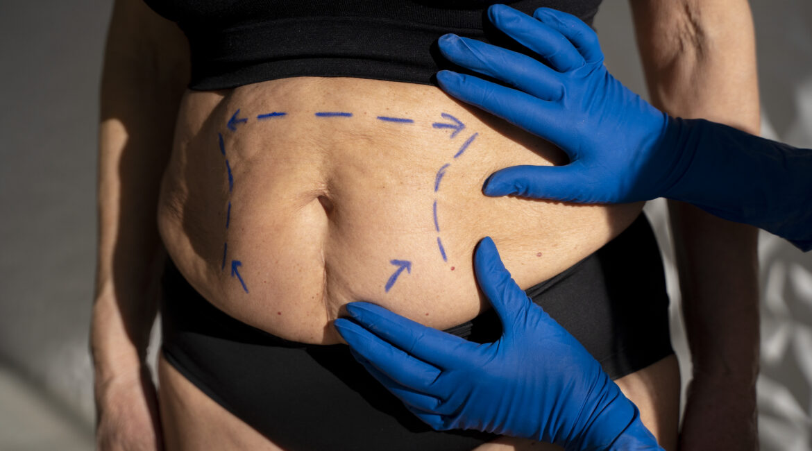 Liposuction