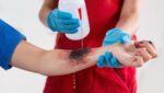 Best Hospital for Burns Treatment in Bangalore