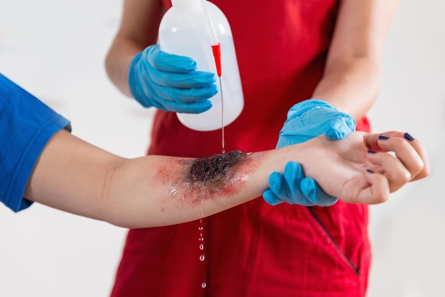 Best Hospital for Burns Treatment in Bangalore